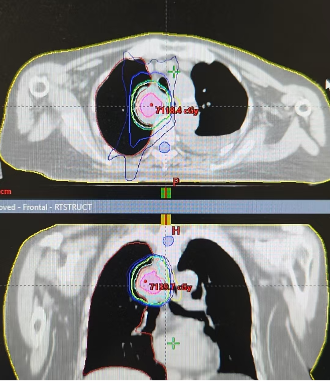 Coronal view radiotherapy dose distribution showing thigh and thoracic target coverage