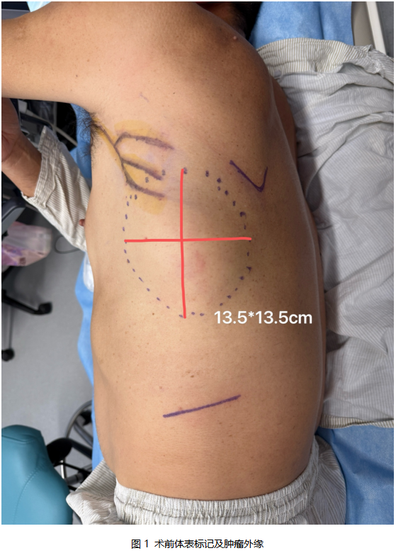 Preoperative body-surface marking outlining a 13.5 by 13.5 centimeter chest wall tumor before en bloc resection — Case Breakthrough Vol. 19