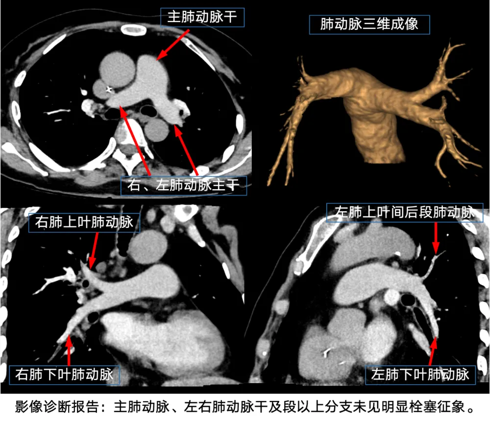 Case Breakthrough Volume 25 — gadolinium dual-low pulmonary CTA in a patient with iodine contrast allergy