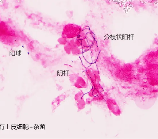 Gram stain of a sputum smear showing Gram-positive slender branching bacilli together with Gram-positive cocci and Gram-negative bacilli and epithelial cells