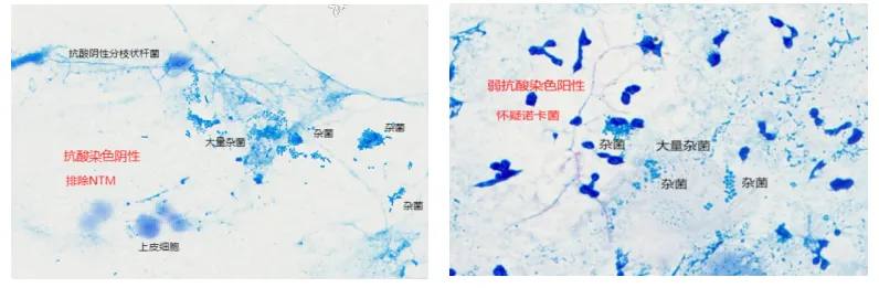 Acid-fast and modified acid-fast staining of the sputum specimen: acid-fast-negative branching bacilli excluding nontuberculous mycobacteria, and weakly acid-fast-positive organisms raising suspicion of Nocardia