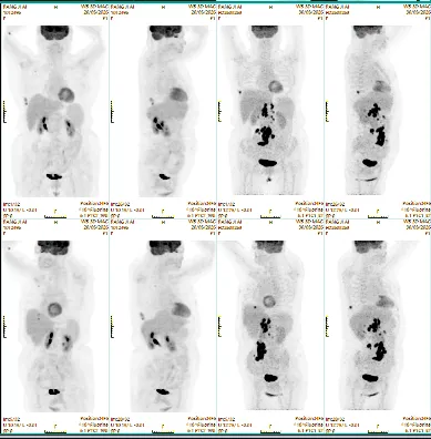 Pre- and post-treatment whole-body MIP PET comparison: left one month after CAR-T infusion, right before treatment