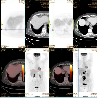 PET-CT after treatment showing the right chest-wall soft-tissue lesion with a fall in SUV from 13.2 to 6.0, consistent with a partial response